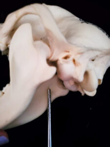 Inferior alveolar nerve block