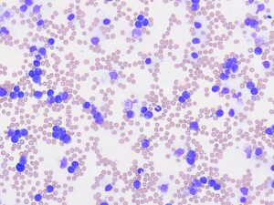 Blood Smear : Hematology in the Point-of-Care Lab